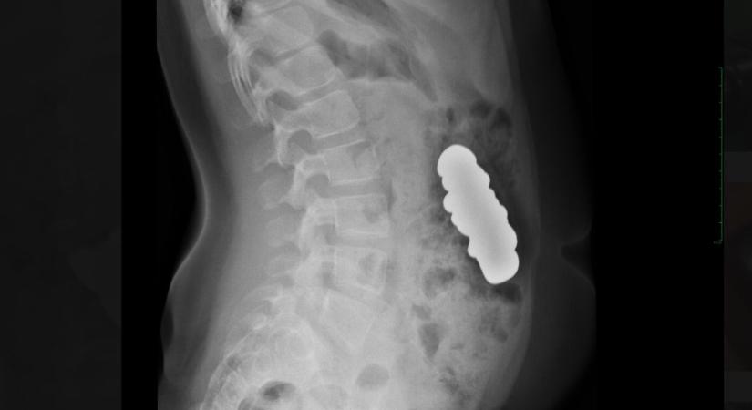 Húsz mágnest nyelt le egy gyerek