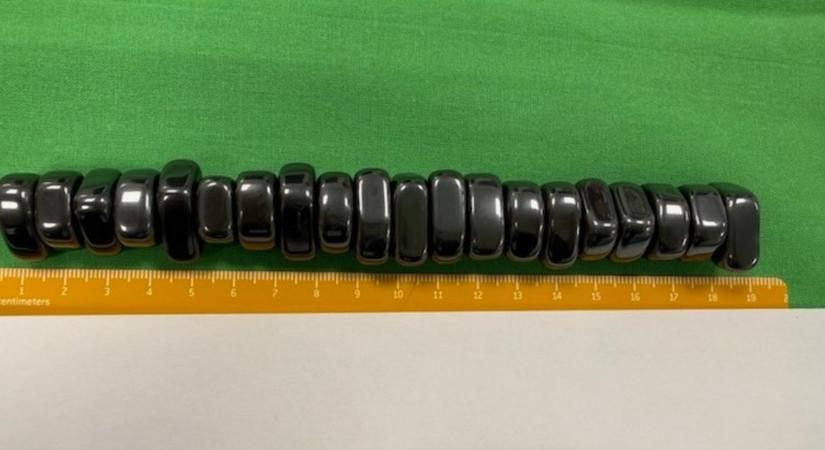 Húsz darab mágnest nyelt le egy tízéves gyerek Budapesten