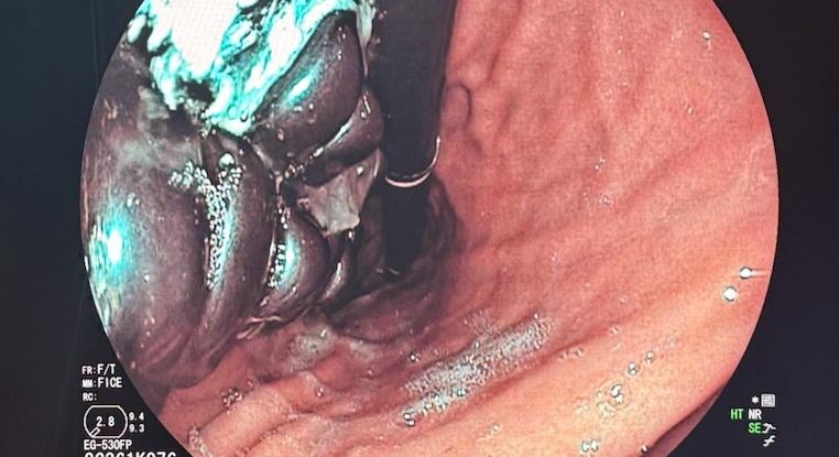 20 mágnest nyelt le egy 10 éves gyerek, a Heim Pál kórházban mentették meg az életét