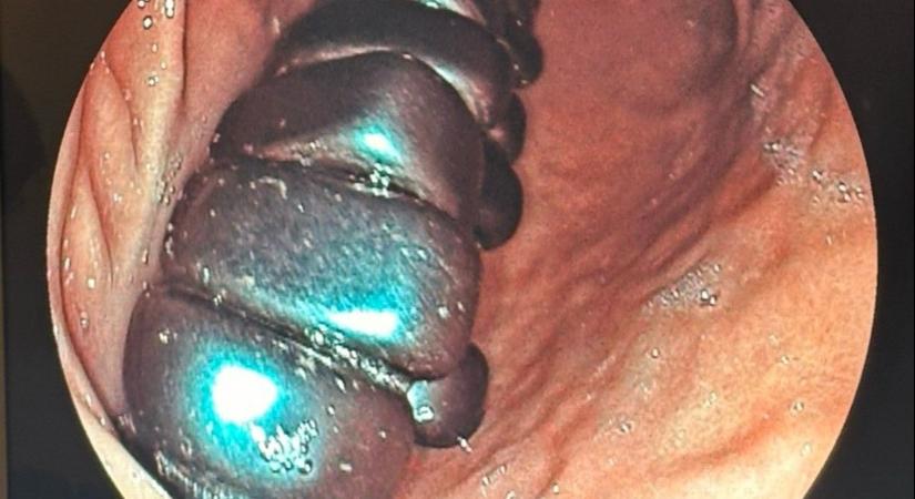 20 mágnest nyelt le egy gyerek, sebészt kellett hívni