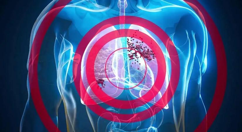 Ez a két hétköznapi betegség megnöveli a tüdőrák későbbi kockázatát