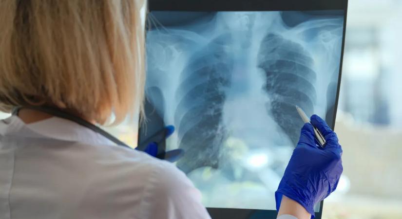 Ha ilyen tüneteid vannak, valószínűleg TBC-d van