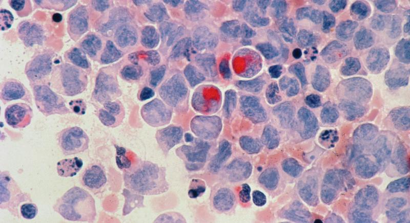 Sok életet menthet a mesterséges intelligencia: így gyorsítja a vérrák diagnosztikáját