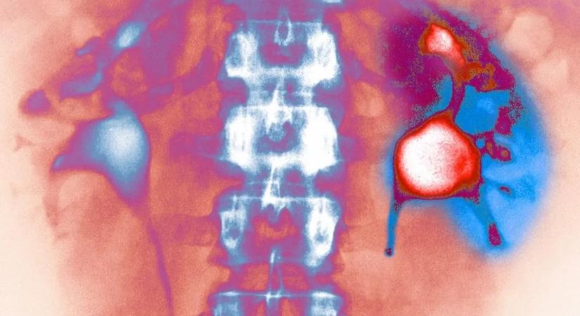 A több víz ivása sem óv meg a vesekő kiújulásától
