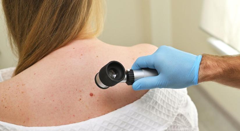 A korai diagnózis életet menthet – ingyenes szűrővizsgálatokat hirdetnek a bőrrák felismerésére