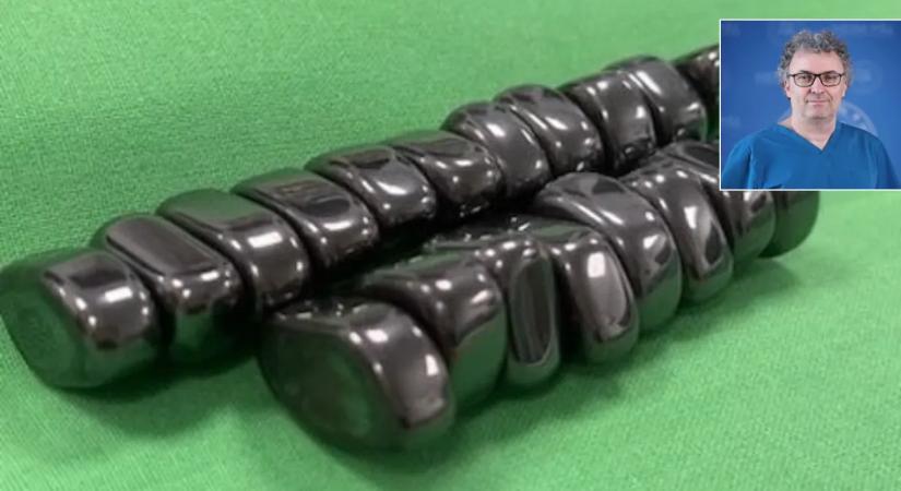 Egy hétig a gyermek gyomrában lehettek a mágnesek – megszólal a műtétet felügyelő orvos