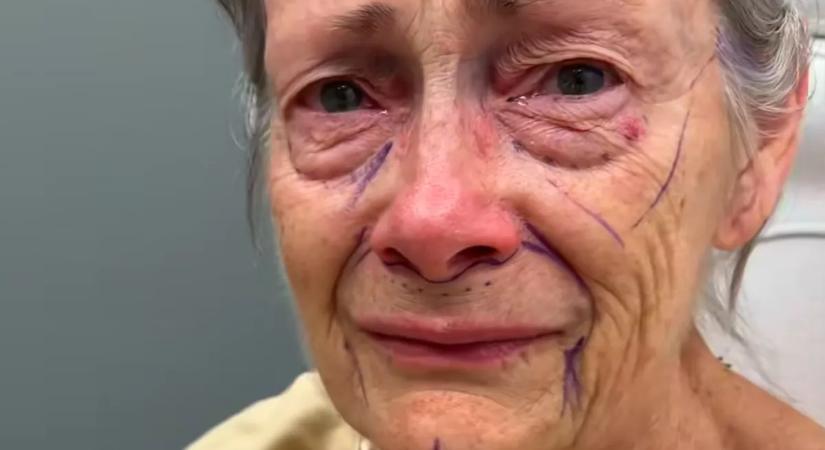 Csodaként terjed a plasztikai beavatkozás: évtizedekkel lett fiatalabb a nagyi