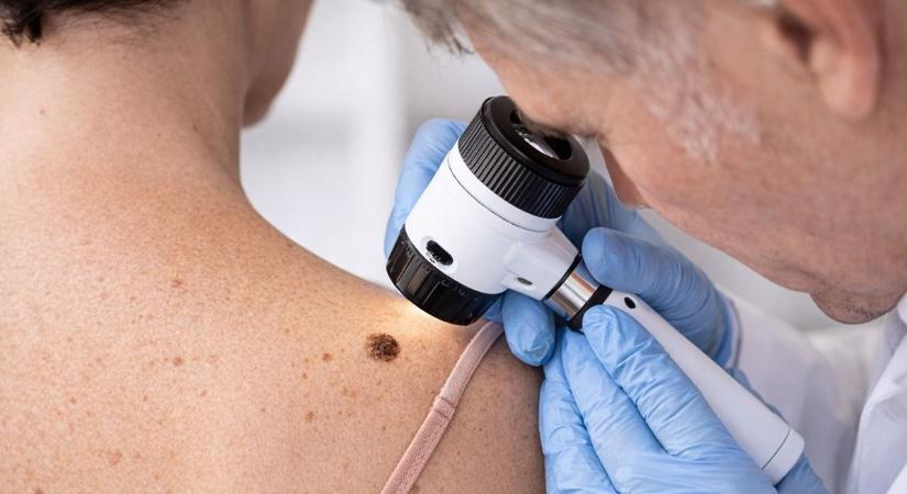 A bőrrák időben felismerve kezelhető – országos kampány indul a megelőzésért