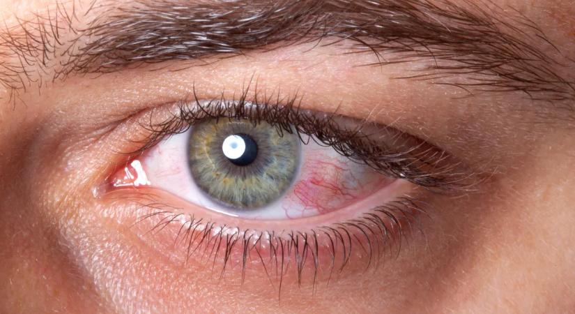 Végleges látásvesztést okozhat ez az ártalmatlannak hitt tünet