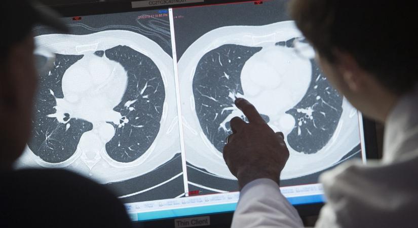 Magyar áttörés: kiderült, min múlik, hogy kinél hat a rákellenes kezelés, és kinél nem