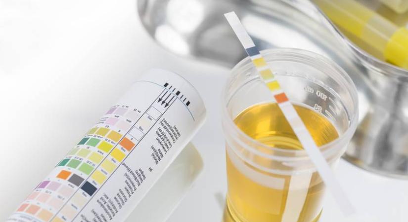 Nagy bajt jelezhet, ha ilyen a vizeleted: fordulj orvoshoz, ha ezt tapasztalod