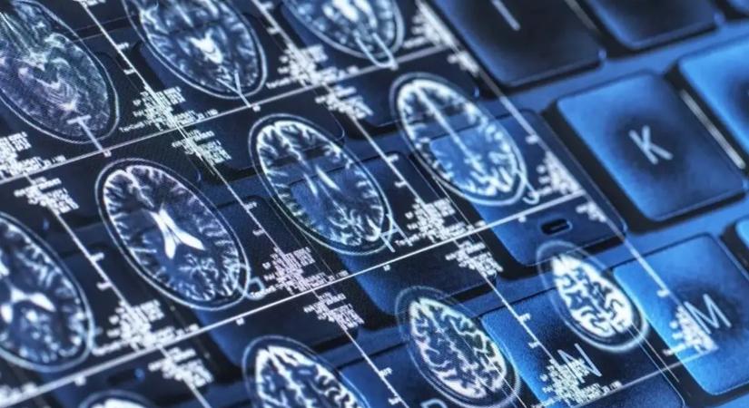 Az MI majdnem 100 százalékos pontossággal megjósolja az Alzheimer-kór kialakulását