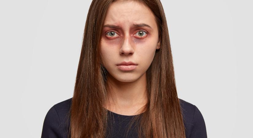 Viszket, ég a szeme? Lehet, hogy apró atkák okozzák a bajt