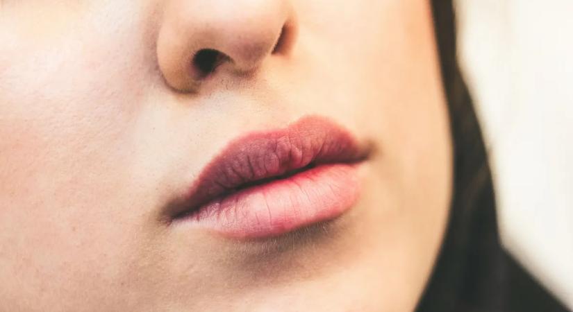 Fájdalmas repedések a szájzugban? Így kezelheti gyorsan