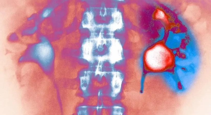 A több víz ivása sem óv meg a vesekő kiújulásától