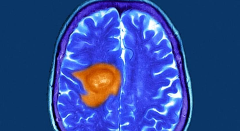 Megvan a vitamin, ami legyőzheti a leghalálosabb agydaganatot