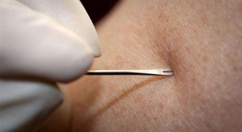 Melanoma bőrrák elleni oltást kapott az első orosz beteg – kifejlesztői szerint szuper hatékony