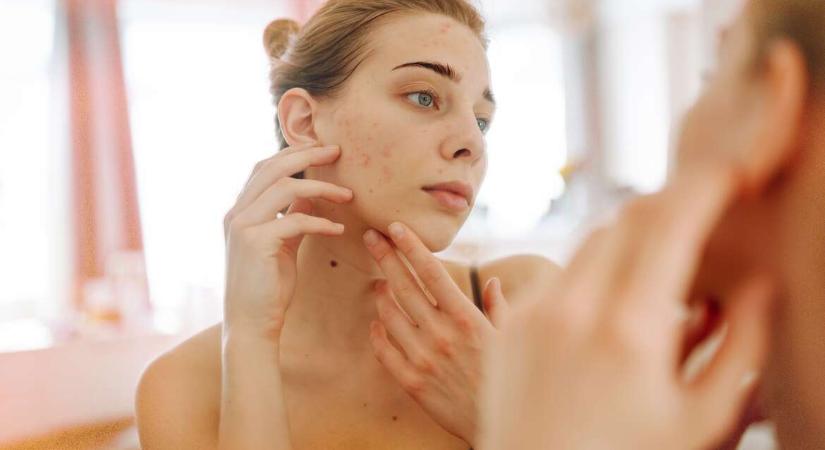 Pattanás, szárazság, ragyogás, mattság: a bőr üzenőfalként jelzi, mi történik odabenn