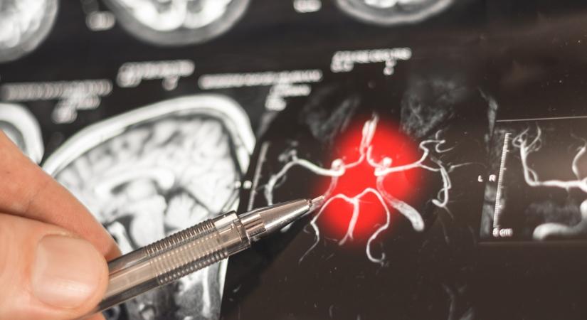 Egy vitamin adhat új esélyt agydaganat ellen