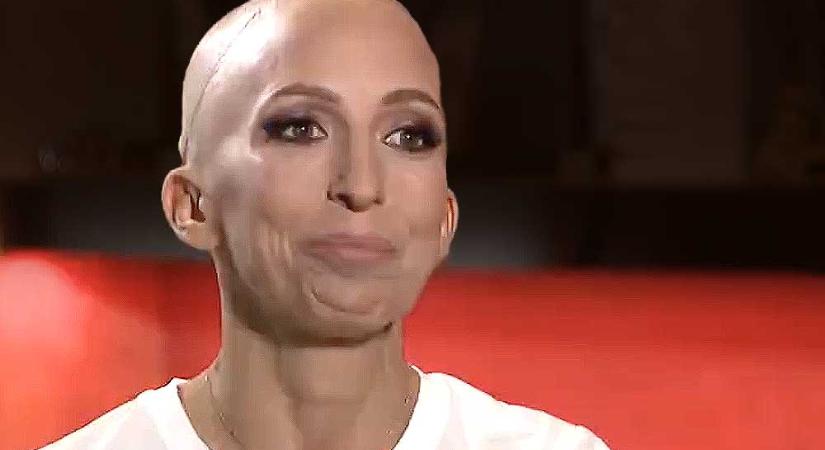 Rubint Réka döbbenetes vallomása: évek óta daganatos betegséggel küzd, a kezelések miatt a haját is elveszítette