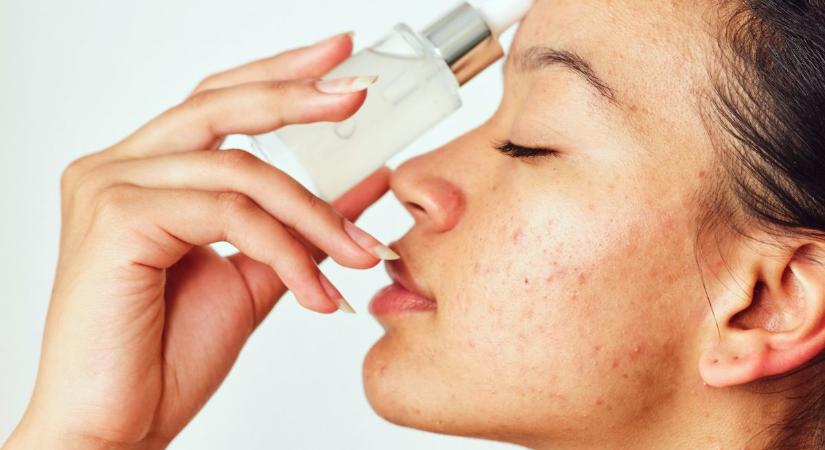 Kevesen használják, pedig ez a hatóanyag egyszerre segít akné és rosacea esetén is – ezt keresd az összetevők között a bőrgyógyász szerint