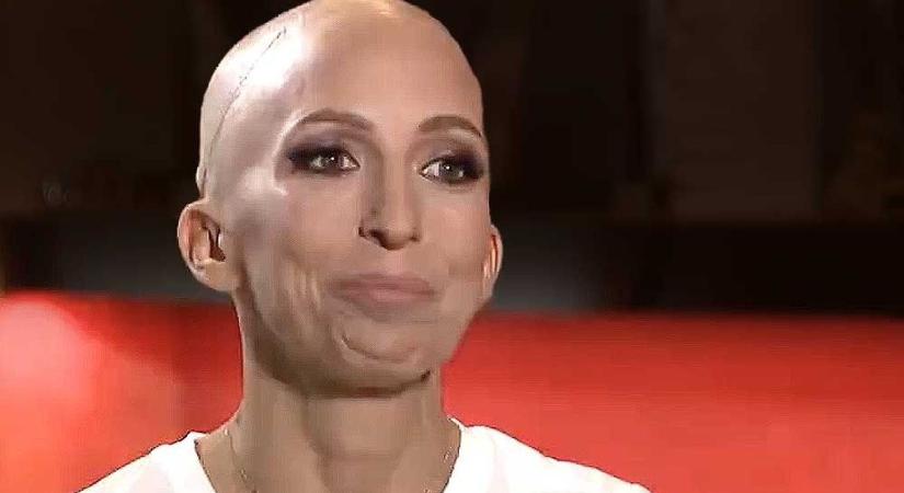 Rubint Réka rákbetegséggel küzd, paróka nélkül beszélt élete legnehezebb időszakáról – fotóval, videóval