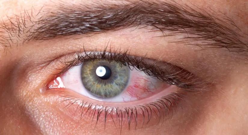 Végleges látásvesztést okozhat ez az ártalmatlannak hitt tünet