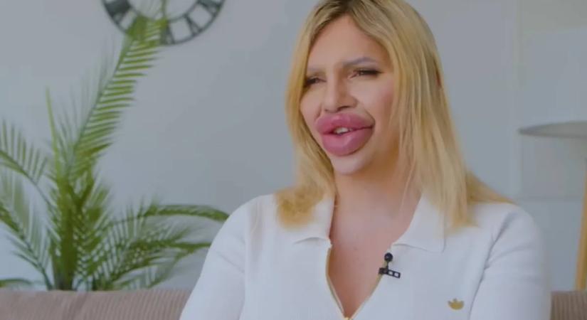 1 liter töltőanyag: "Enyém a világ legnagyobb ajka, de még nagyobbat akarok!"