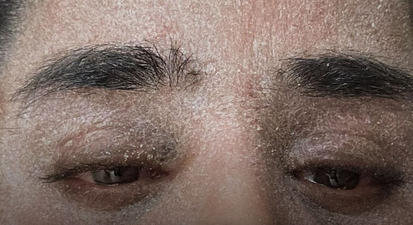 Sokkoló: elefántbőre lett a nőnek, miután nem szedi tovább a gyógyszerét