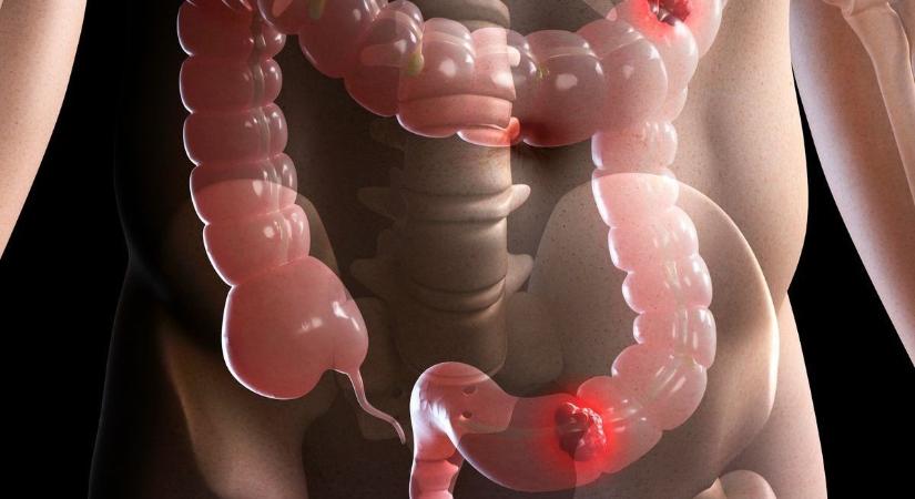 Ne várj addig, amíg már késő lesz – csendben, alattomosan öl ez a daganat!