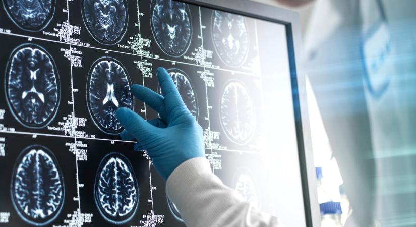 Ez az ártatlannak tűnő szer felgyorsíthatja a demenciát