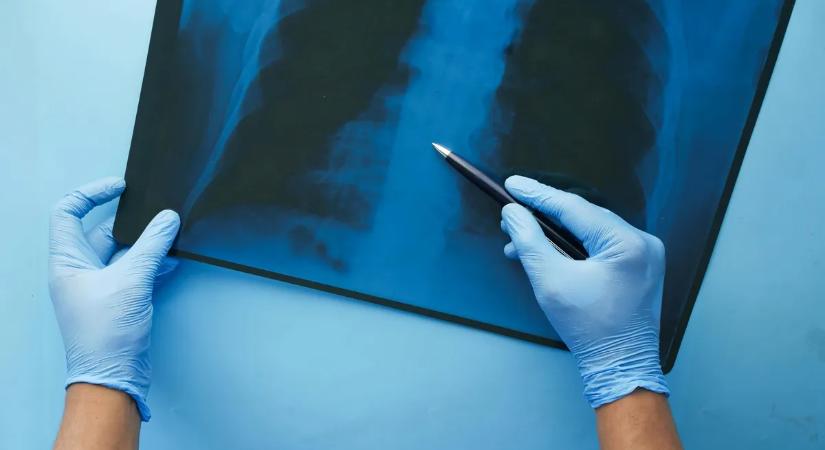 A fiatal nem tudta abbahagyni az e-cigaretta használatát, borzalmas következménye lett