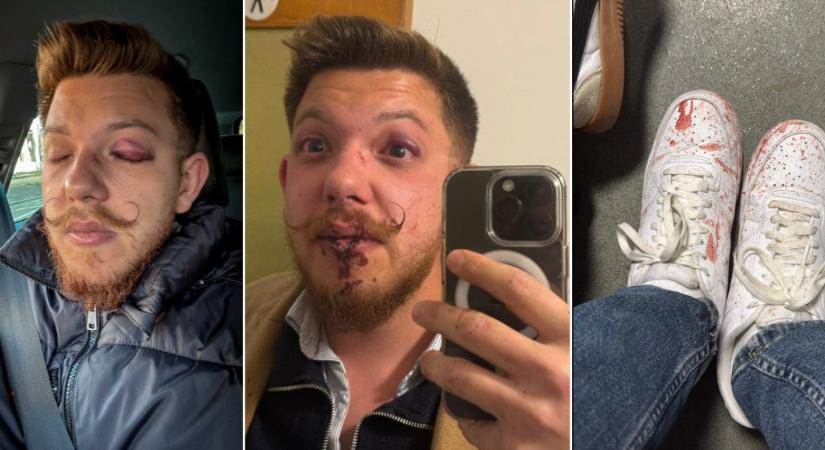 Tiszás szlogent kiabáló fiatalokat vertek össze Sepsiszentgyörgyön