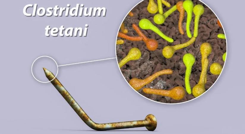 Sok minden téves, amit a tetanuszról tudni véltünk