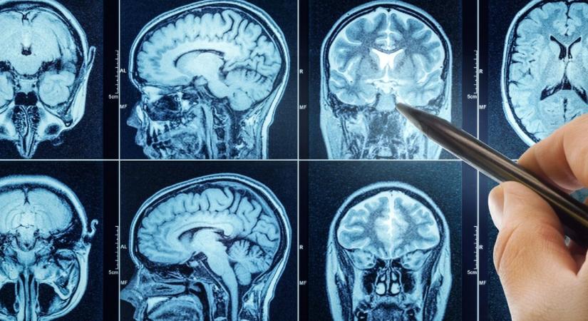 Megtalálták az agy kapcsolóját, ami leállítja az étvágyat