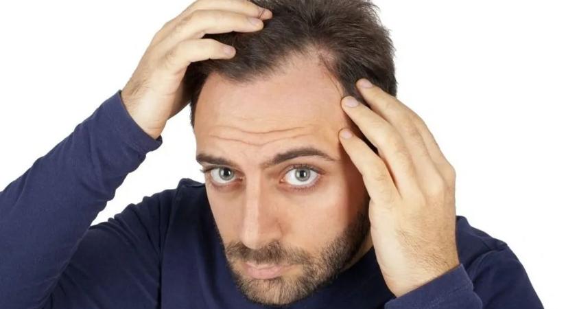Megvan a kopaszodás ellenszere – ezt kell tenni a kutatók szerint