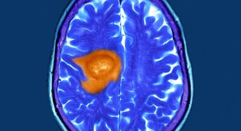 Megvan a vitamin, ami legyőzheti a leghalálosabb agydaganatot