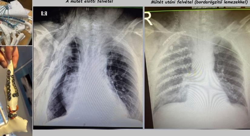 Világszínvonalon látják el a mellkasi sérülteket a győri kórházban