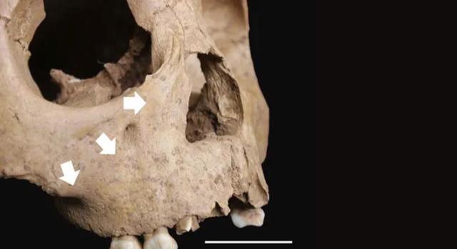 Őskori leletek írhatják át a szifilisz eredetéről alkotott képet