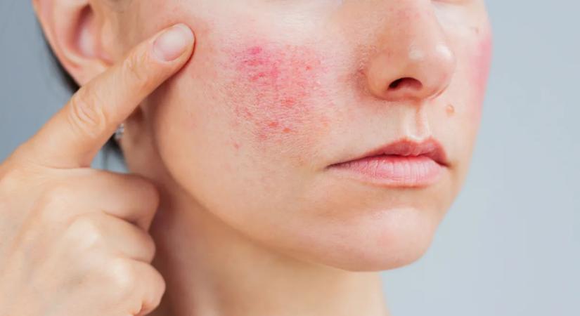 Ronthatja a glutén az ekcéma tüneteit? Íme az igazság!