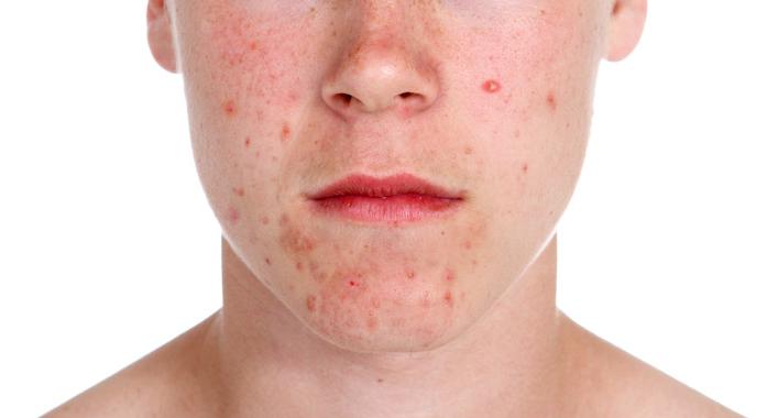 Pattanások - mikor érdemes bőrgyógyászt felkeresni?