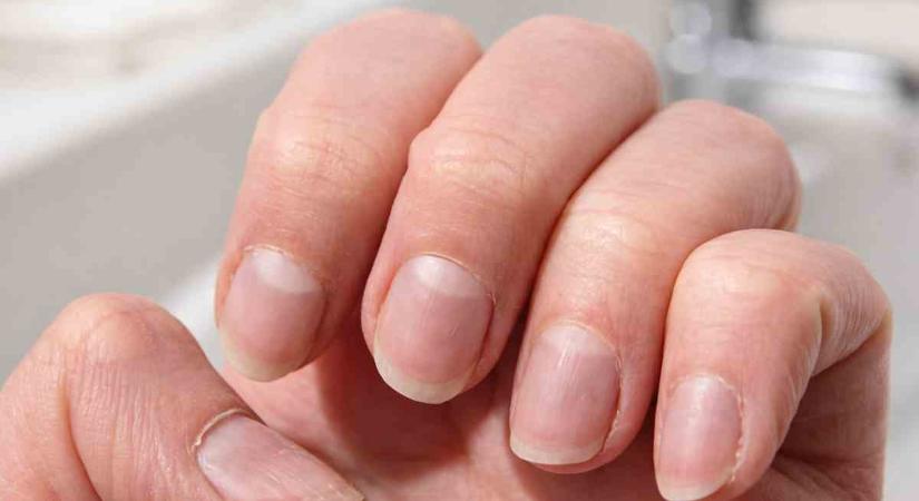 Szinte mindenkinek vannak ilyen vonalak a körmein, de csak nagyon kevesen tudják, mit jelentenek