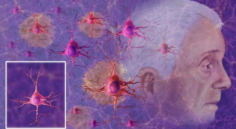Bűzös megoldás az Alzheimer-kór ellen