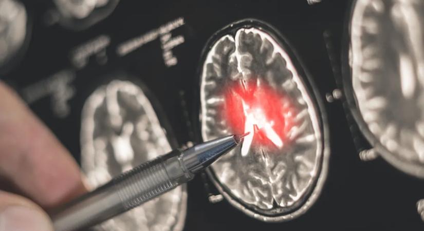 A remegésen túl: amit feltétlenül tudnod kell a Parkinson-kórról