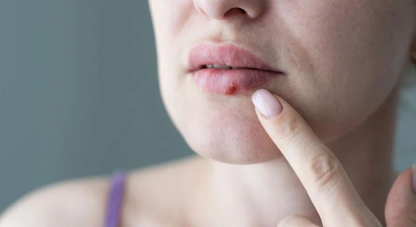 Ajakherpesz: a többség rosszul kezeli – Ezeket a hibákat kell elkerülni