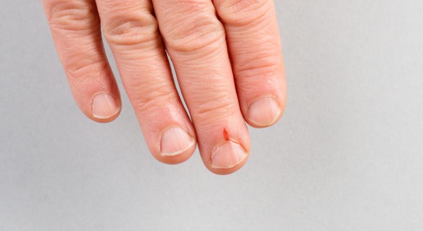 Vonalak a körmön: betegség jele, vagy teljesen ártalmatlan jelenség?