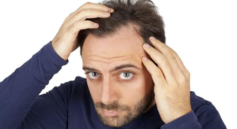 Megvan a kopaszodás ellenszere – ezt kell tenni a kutatók szerint