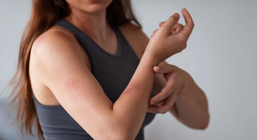 Ritka allergia tartja fogságban: a nőnek a napfény is fájdalmat okoz
