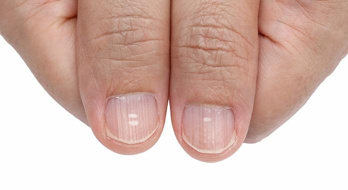 Mitől töredezik a körmöd? Tényleg a kalciumhiány az oka?