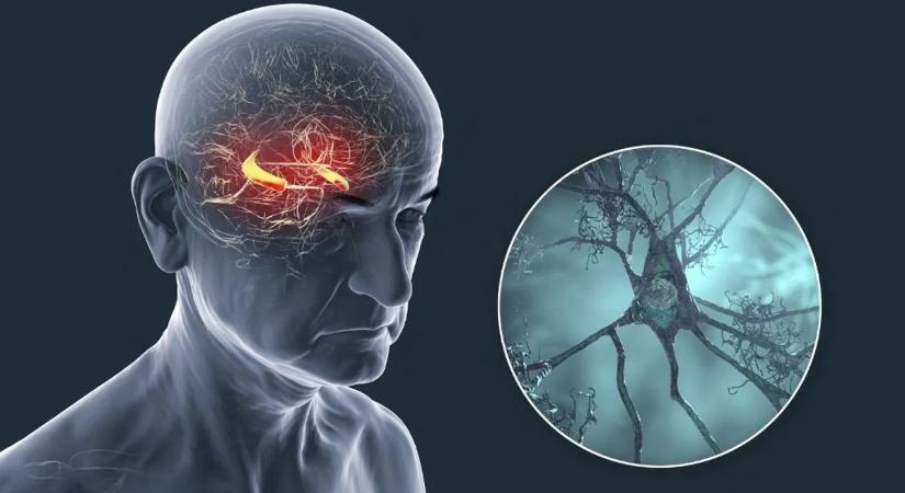Új felfedezés: nem csak a plakkok felelősek az Alzheimer-kórért